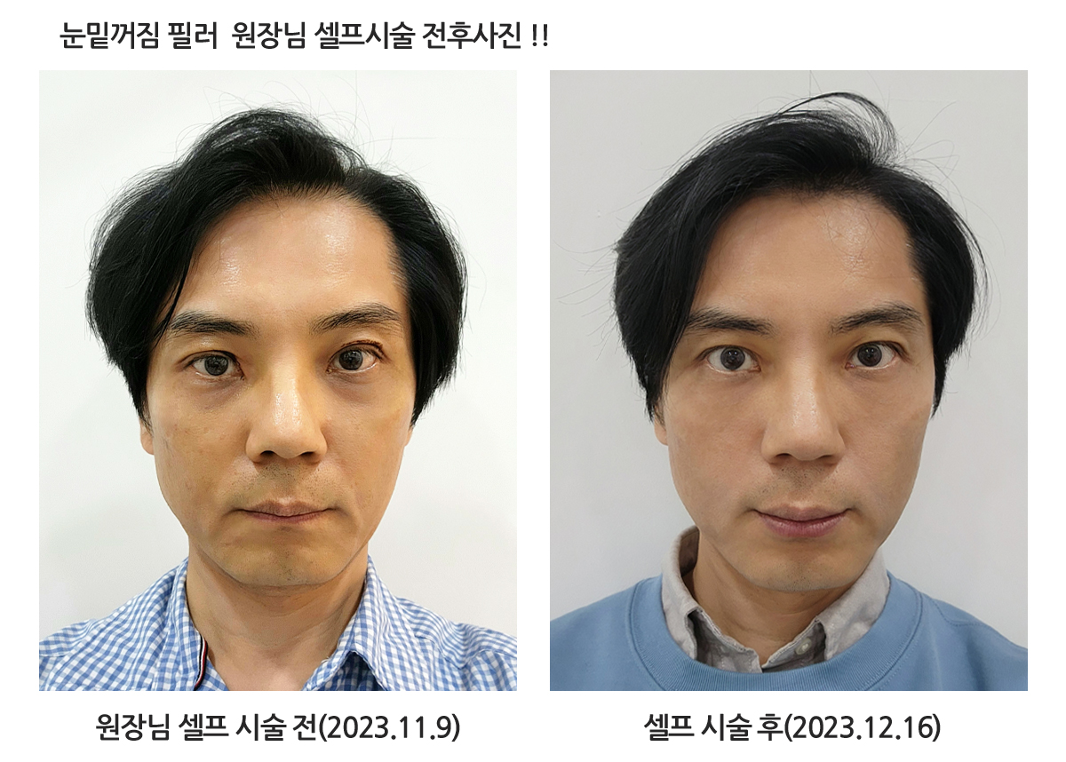 필러 전체 안내 자료 5